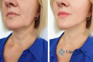 Double chin before and after Hi-Fu treatment 4 Book your double chin treatment Sutton in Ashfield today! We are here to help!