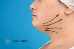 Double chin before and after Hi-Fu treatment 3 Boost your confidence with a Double chin treatment Sutton in Ashfield