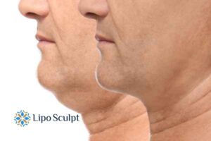 Double chin before and after Hi-Fu treatment 2 Double chin treatment Sutton in Ashfield from Lipo Sculpt - feel more confident today!