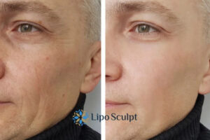How to Fight Aging Symptoms 3 Fight Aging Symptoms Sutton in Ashfield With HIFU and Morpheus8 Today!