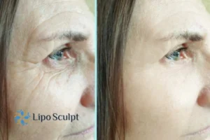 How to Fight Aging Symptoms 2 Do you want to Fight Aging Symptoms Sutton in Ashfield? Contact Lipo Sculpt today!