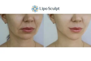 Explaining Total Skin Tightening Treatment And What It Can Do For You 2 Do you want to boost your self confidence? Give Morpheus8 Sutton in Ashfield a try today!