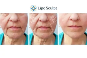 Explaining Total Skin Tightening Treatment And What It Can Do For You 3 Boost your confidence with Morpheus8 Sutton in Ashfield call our team today!