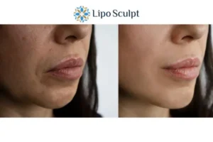 Explaining Total Skin Tightening Treatment And What It Can Do For You 4 Morpheus8 Sutton in Ashfield the best results - call our team today!