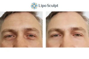 Explaining Total Skin Tightening Treatment And What It Can Do For You 6 Morpheus8 Sutton in Ashfield book in today to find out more!