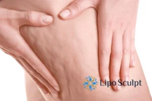CoolSculpting for Legs: The Innovative Approach to Redefining Your Legs 5 Start your journey today book your coolsculpting treatment Sutton in Ashfield online today!